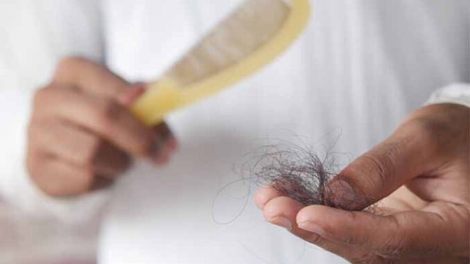 Alopecia juga beresiko pada wanita