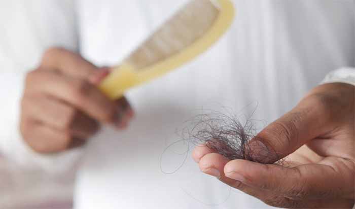 Alopecia juga beresiko pada wanita