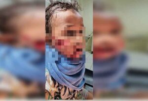 Anak 3 Tahun Digigit Anjing, Diduga Anjing Rabies